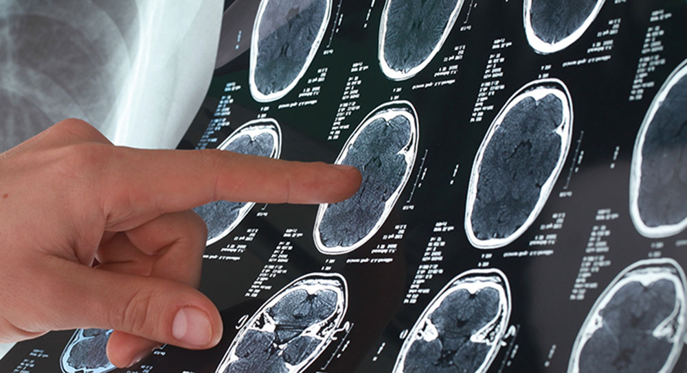 A finger points to something on the X-ray of a brain