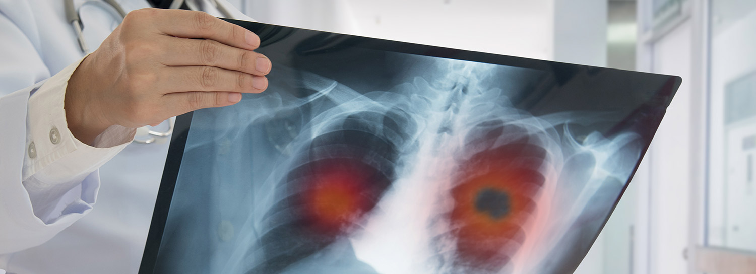 doctor holding an xray of lung cancer
