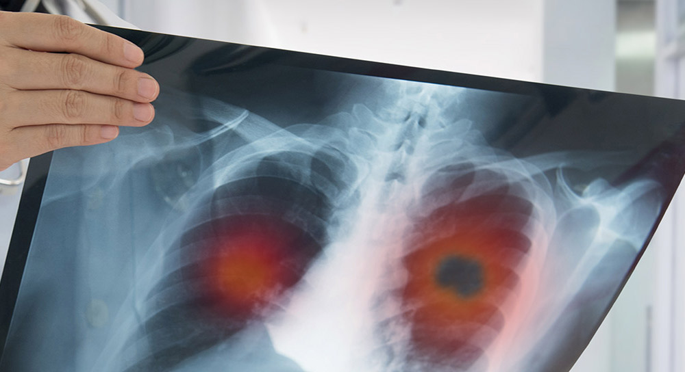 Image of a lung X-ray 