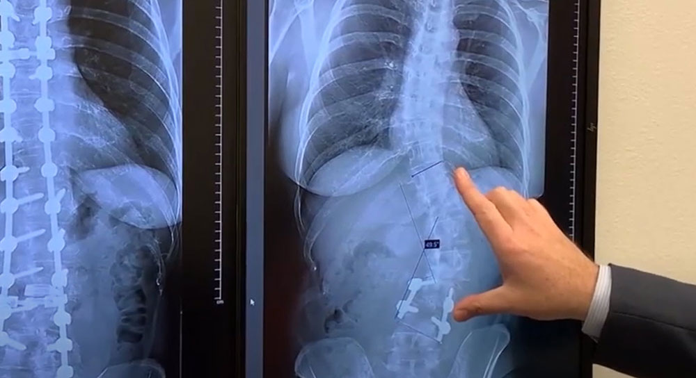 Scoliosis X-Ray