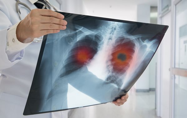 Lung Nodule Program
