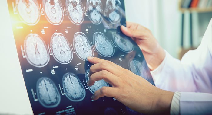 a doctor holds up a sheet of x-ray images of the brain