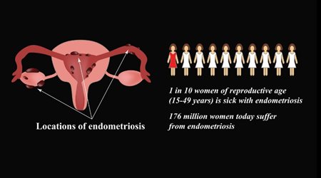 A graphic showing a uterus with locations of endometriosis
