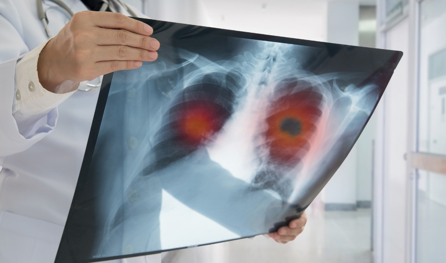 Speedier discovery spurs better outcomes with lung cancer