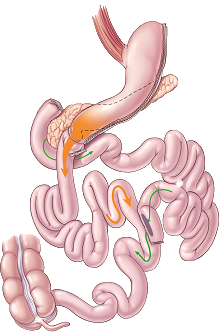 Diagrama del cruce duodenal