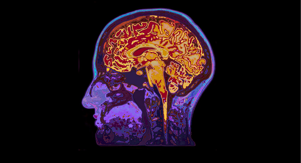 COVID-19 can increase your risk of stroke