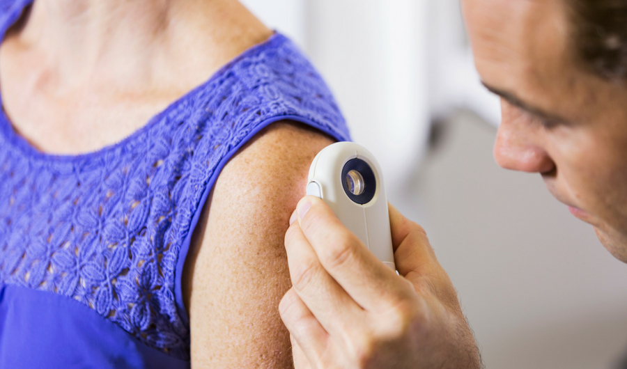 Check Yourself for the ABCDE Signs of Melanoma