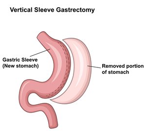 graphic of sleeve gastrectomy