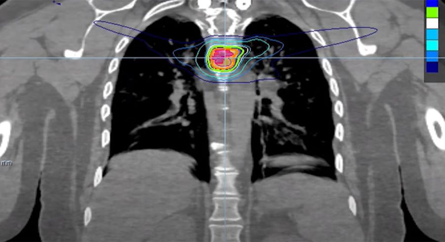 an X-ray of Mindy Calisso's sternum