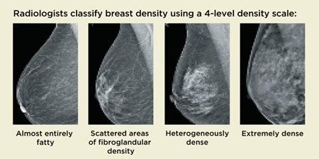 4 Level Breast Density Scale