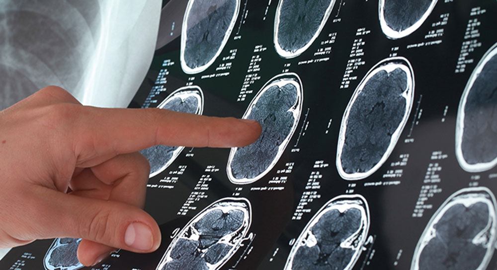 A white hand points at a scan showing multiple human brain images